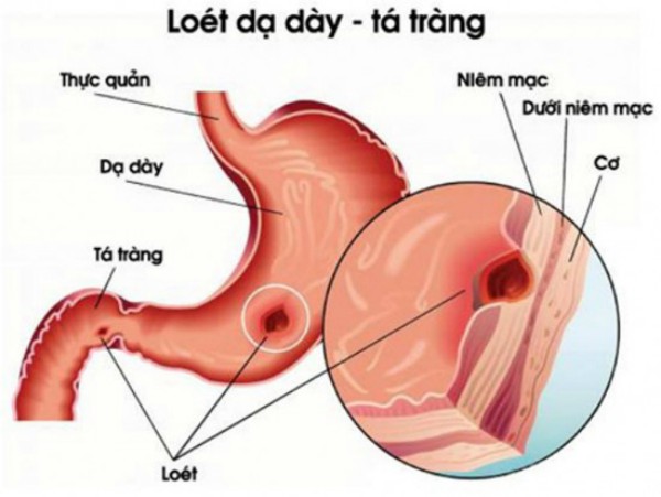 Tức giận có thể làm loét dạ dày.